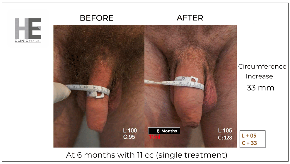 penis filler results before and after