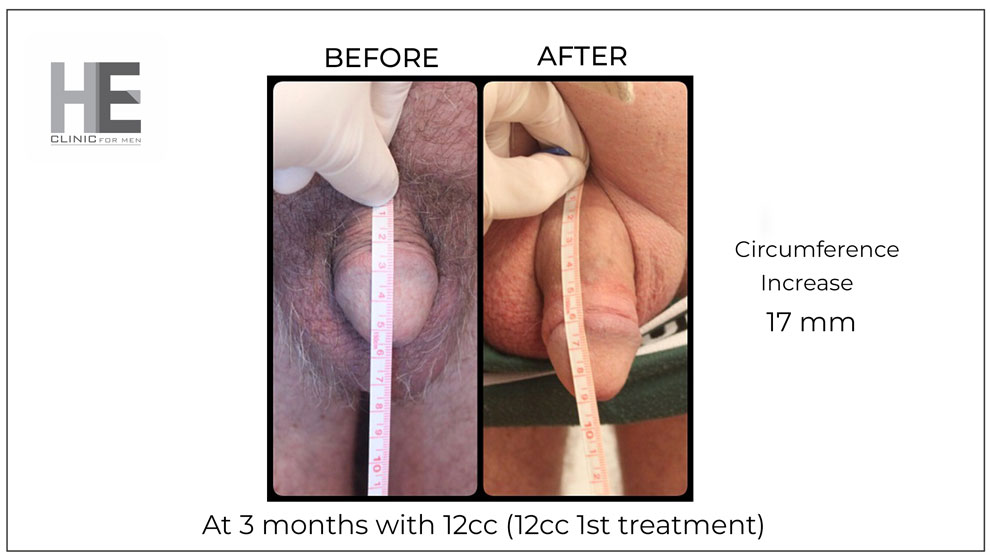 before and after penis filler