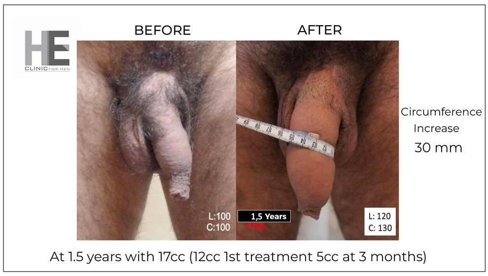 before and after pic penis filler.