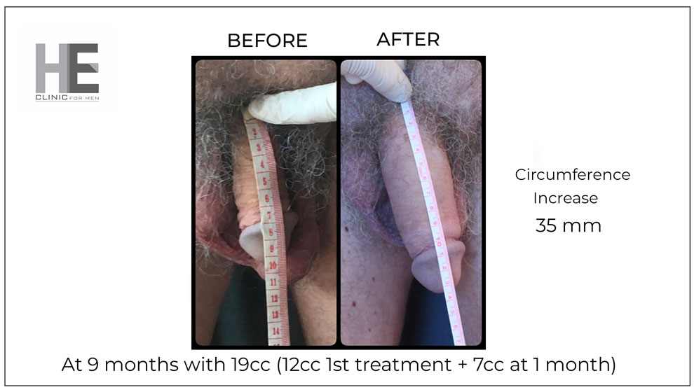 before and after penis filler