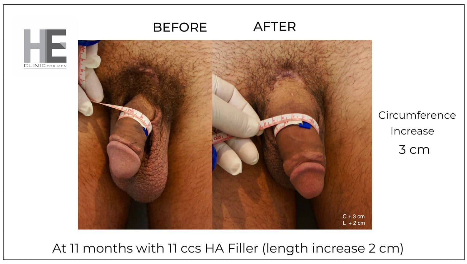 Before and after picture of penile enhancement at HE Clinic bangkok