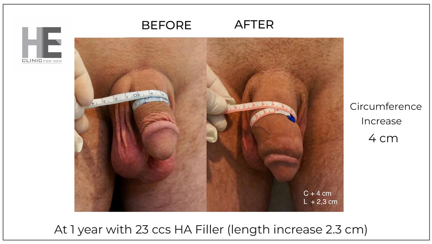 phalloplasty with HA filler at HE Clinic Bangkok