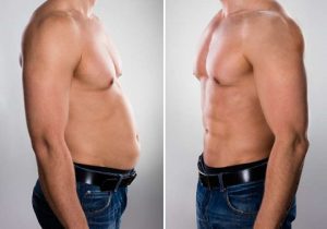 coolsculpting can reduce fat without liposuction